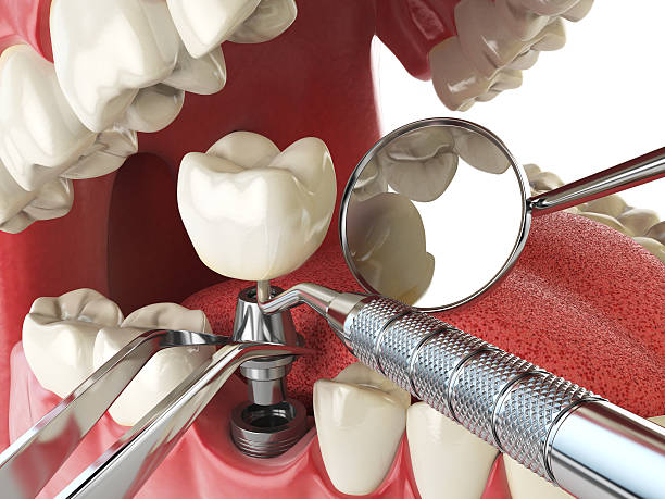 Best Broken or Chipped Tooth Repair in Cedar Grove, FL
